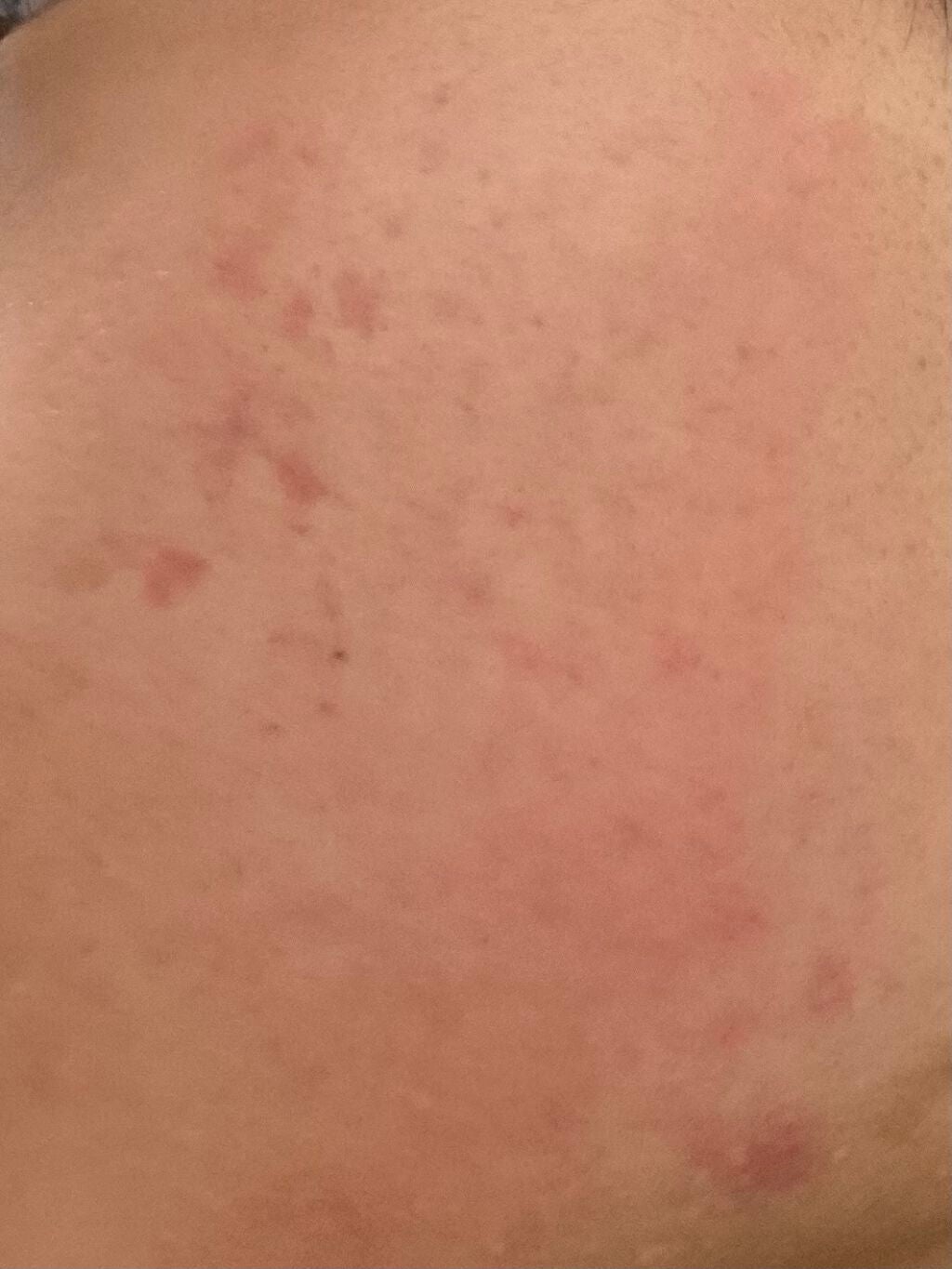 DRX AZAクリア/ロート製薬/その他スキンケアを使ったクチコミ(2枚目)