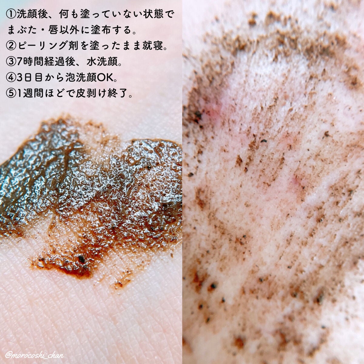 ダーマスキンピーリング/BQCELL/その他キットセットを使ったクチコミ(3枚目)