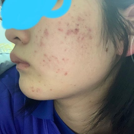 極潤 ヒアルロン乳液(旧)/肌ラボ/乳液を使ったクチコミ(3枚目)