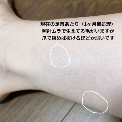 光美容器 光エステ <ボディ&フェイス用> ES-WP81/Panasonic/家庭用脱毛器を使ったクチコミ(5枚目)