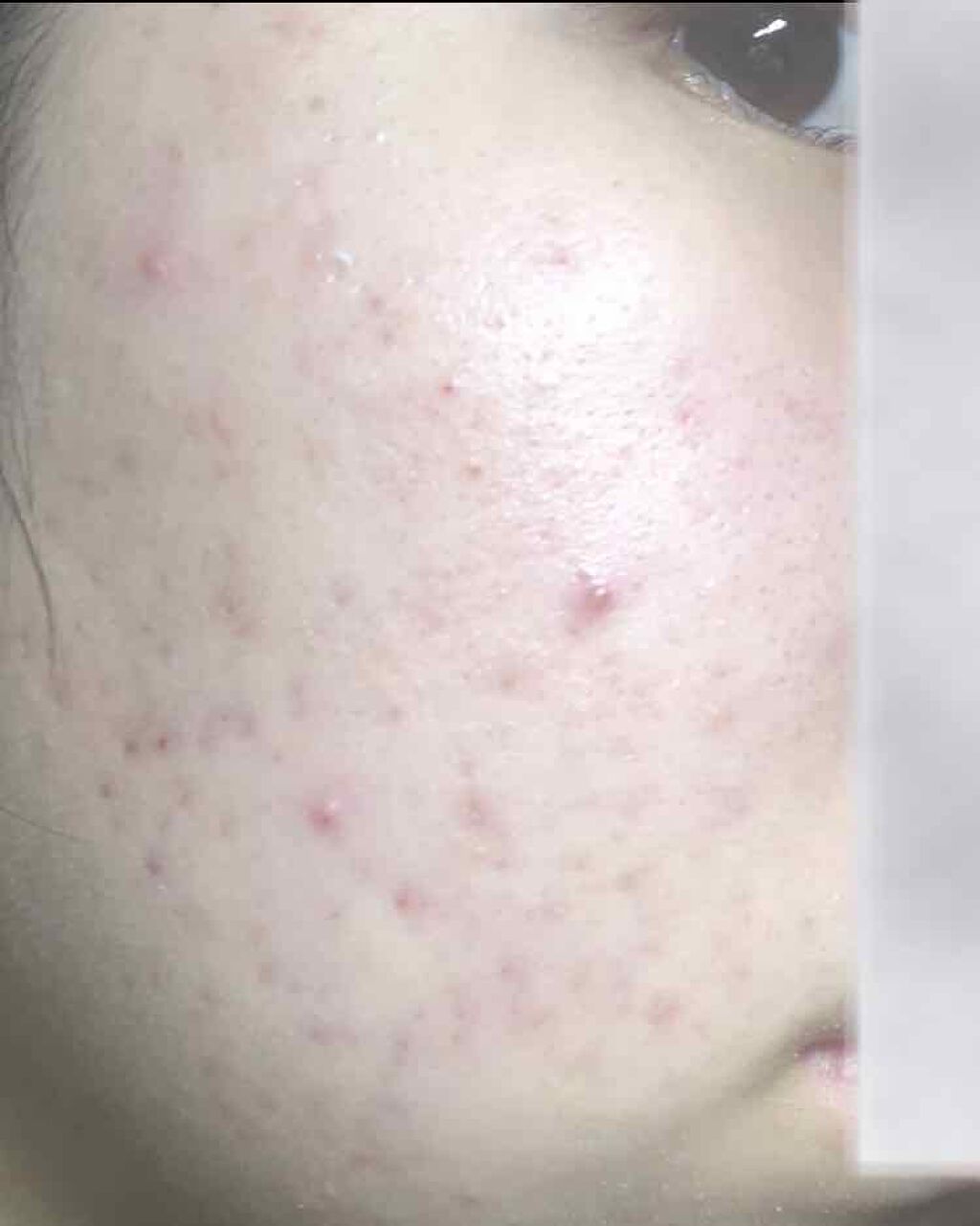 あかね on LIPS 「閲覧注意⚠️2枚目と3枚目比べるとちょっとは薄くなってる!!嬉..」(3枚目)