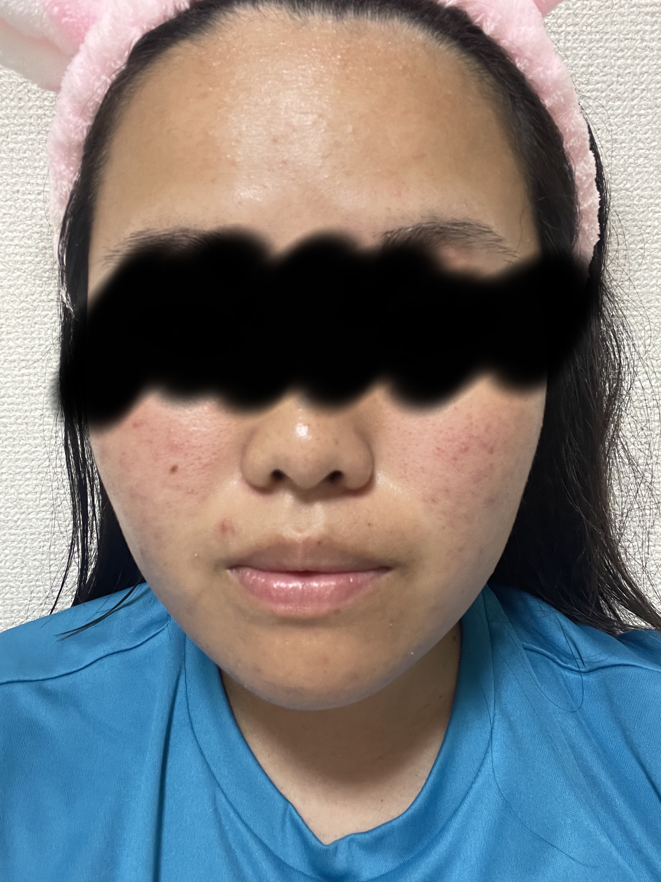 薬用 極潤 スキンコンディショナー/肌ラボ/化粧水を使ったクチコミ（2枚目）