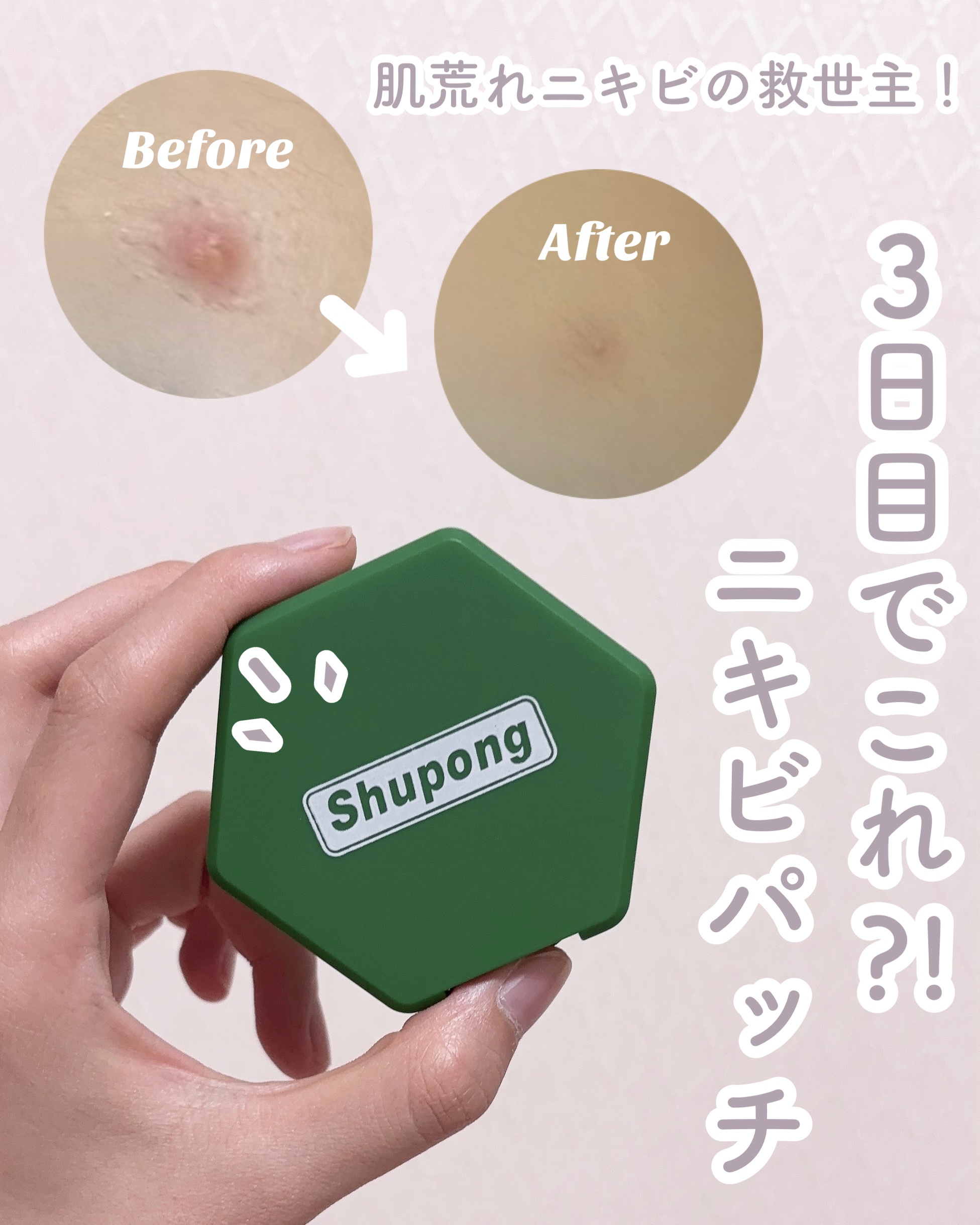 SPOT PATCH ロールタイプ/Shupong/にきびパッチを使ったクチコミ（1枚目）