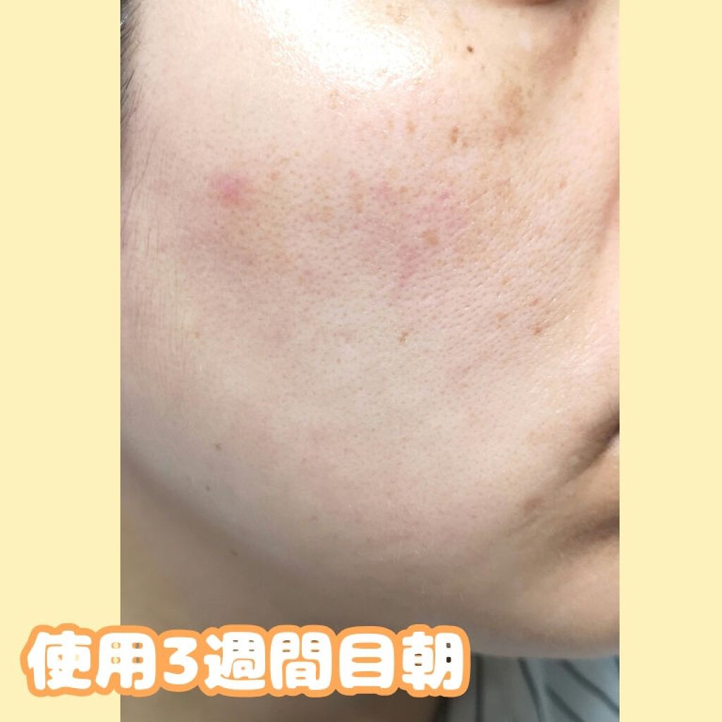 アレルバリア エッセンス BB/d プログラム/BBクリームを使ったクチコミ(2枚目)