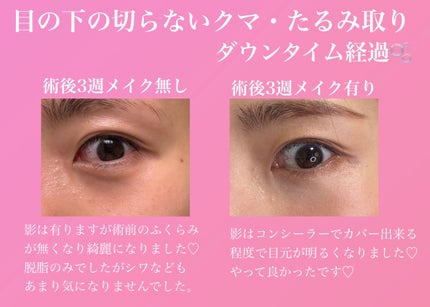 ncosme on LIPS 「湘南美容クリニックで目の下の切らないクマ・たるみ取りをしてきま..」(4枚目)