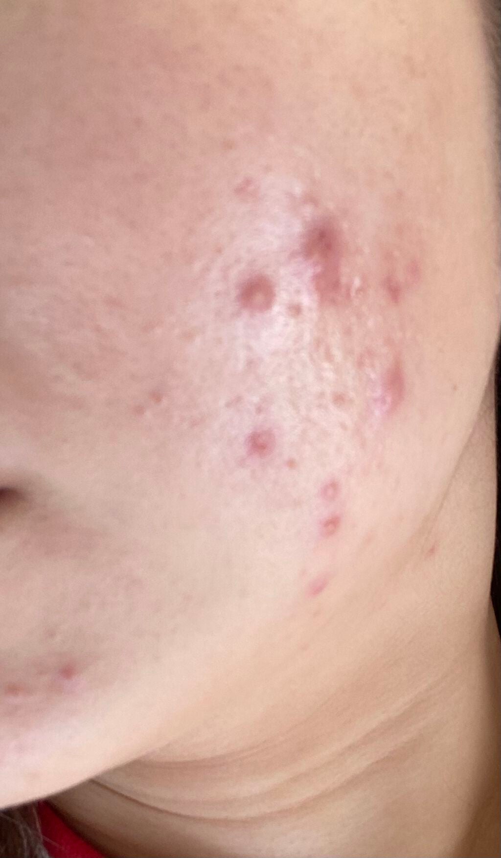 モイスチュア ローション/カルテHD/化粧水を使ったクチコミ(2枚目)