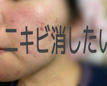 もちこ on LIPS 「いきなり初投稿で汚肌&悩み相談になってしまい申し訳ないです😢私..」（1枚目）