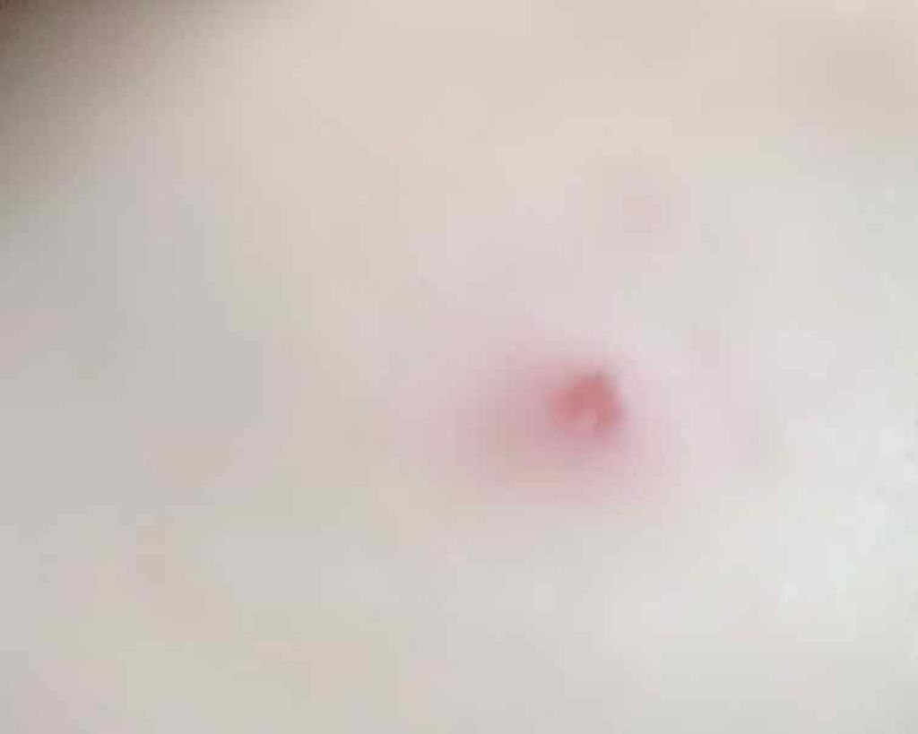 ちょこ on LIPS 「自力で黒子を除去しました😵LIPSに製品情報がなかったのでジャ..」(2枚目)