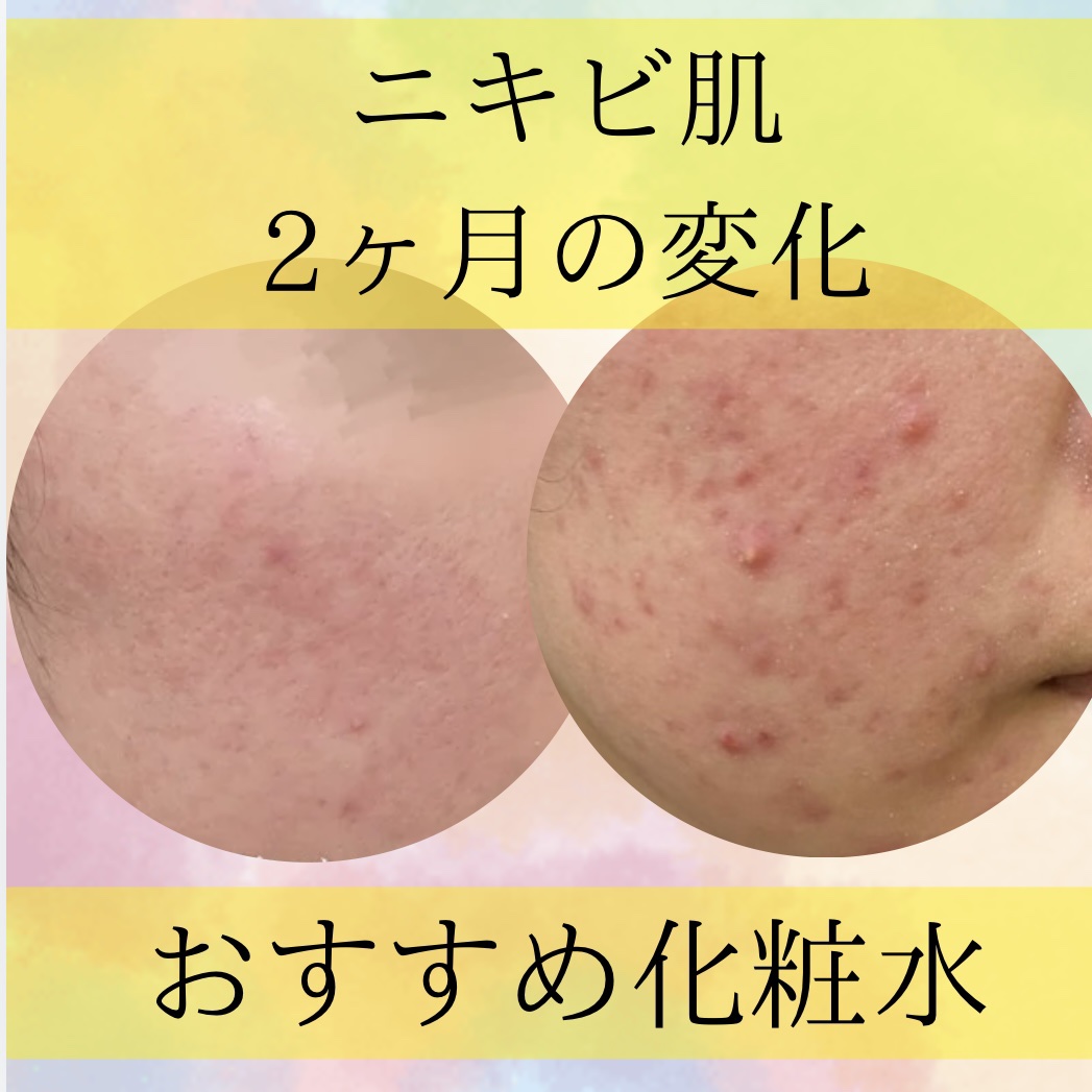 ドクダミ 77 スージングトナー/Anua/化粧水を使ったクチコミ（1枚目）