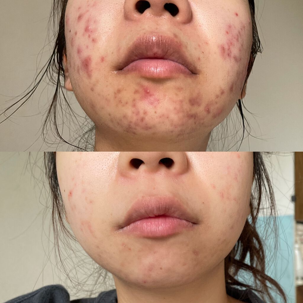 N on LIPS 「みなさんにアドバイスして貰った事を参考にしてスキンケアをしてい..」(1枚目)