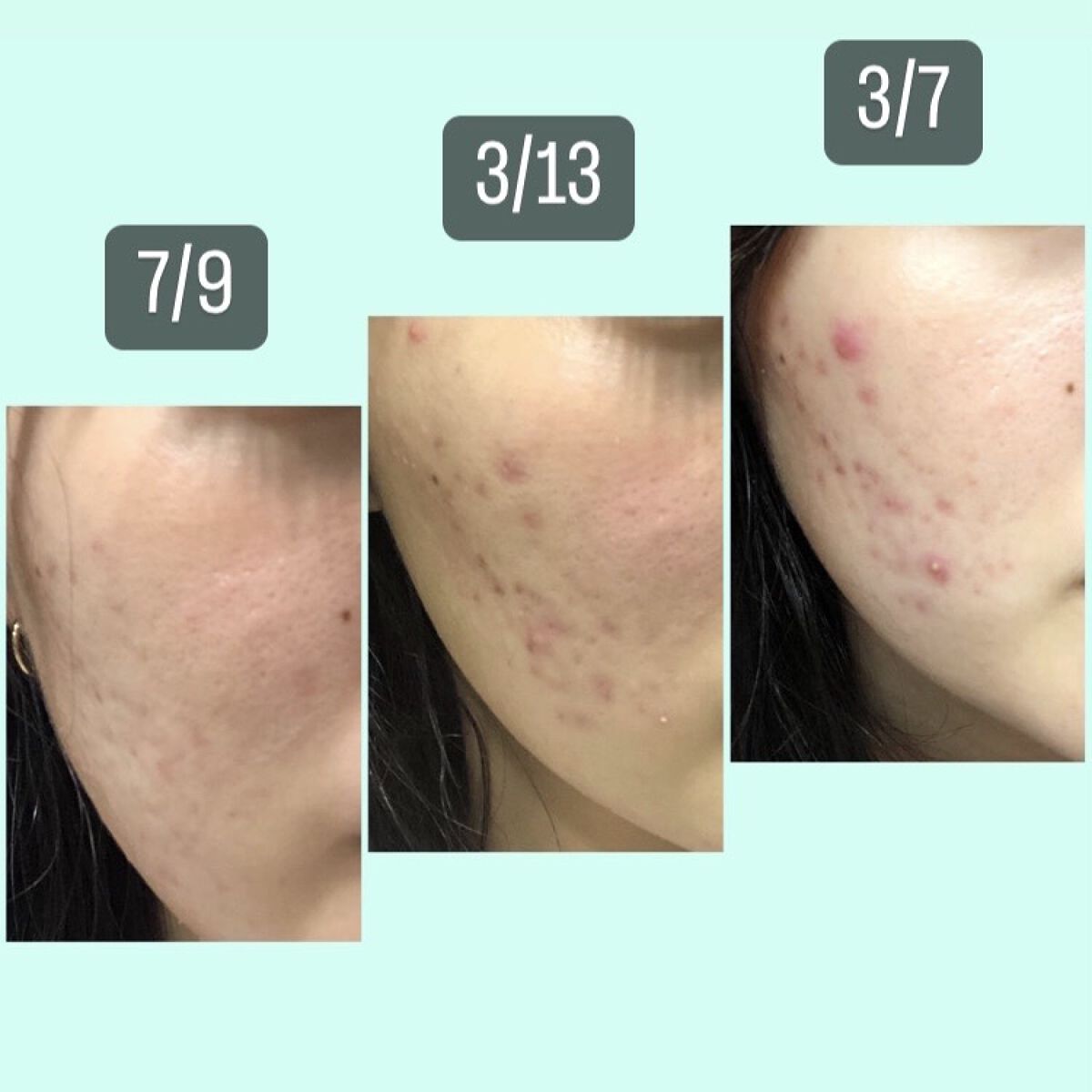 ハトムギ化粧水(ナチュリエ スキンコンディショナー R )/ナチュリエ/化粧水を使ったクチコミ（3枚目）