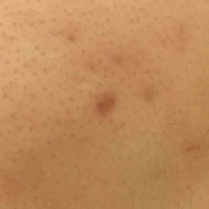 薬用 しみ 集中対策 美容液/メラノCC/美容液を使ったクチコミ(2枚目)