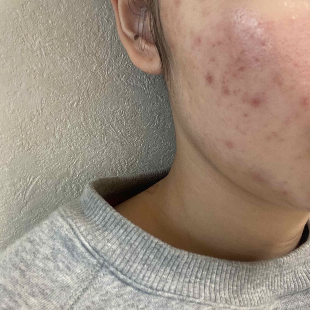 クリンダマイシンゲル(医薬品)/クラシエ薬品/その他を使ったクチコミ（1枚目）