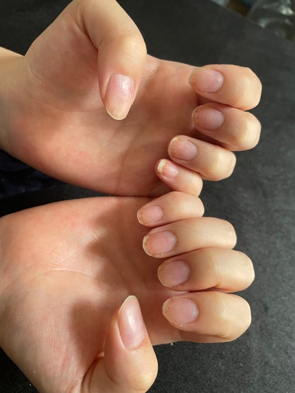 ごんび on LIPS 「ジェルネイルアレルギーについて①🥲(グロ注意)ジェルネイルアレ..」(5枚目)