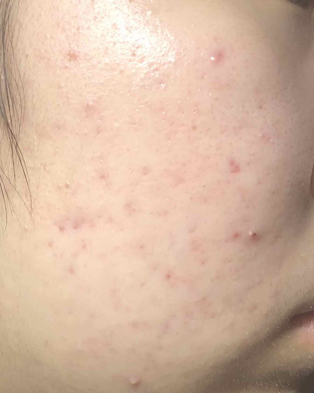 あかね on LIPS 「ニキビ日記右頬結構治ってきてる😭😭でも、いまはマスクで肌荒れが..」(3枚目)