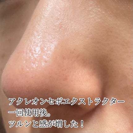 アクレオンセボエクストラクター/ANACIS/その他スキンケアを使ったクチコミ(7枚目)