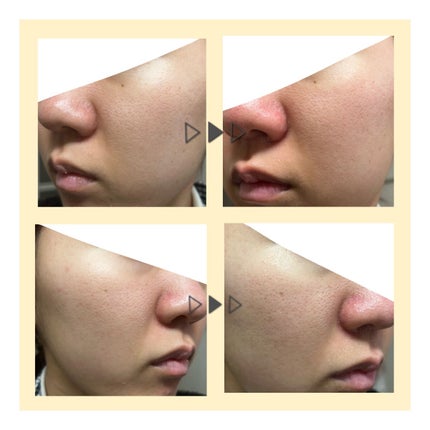 V エッセンス/unlabel/美容液を使ったクチコミ(3枚目)