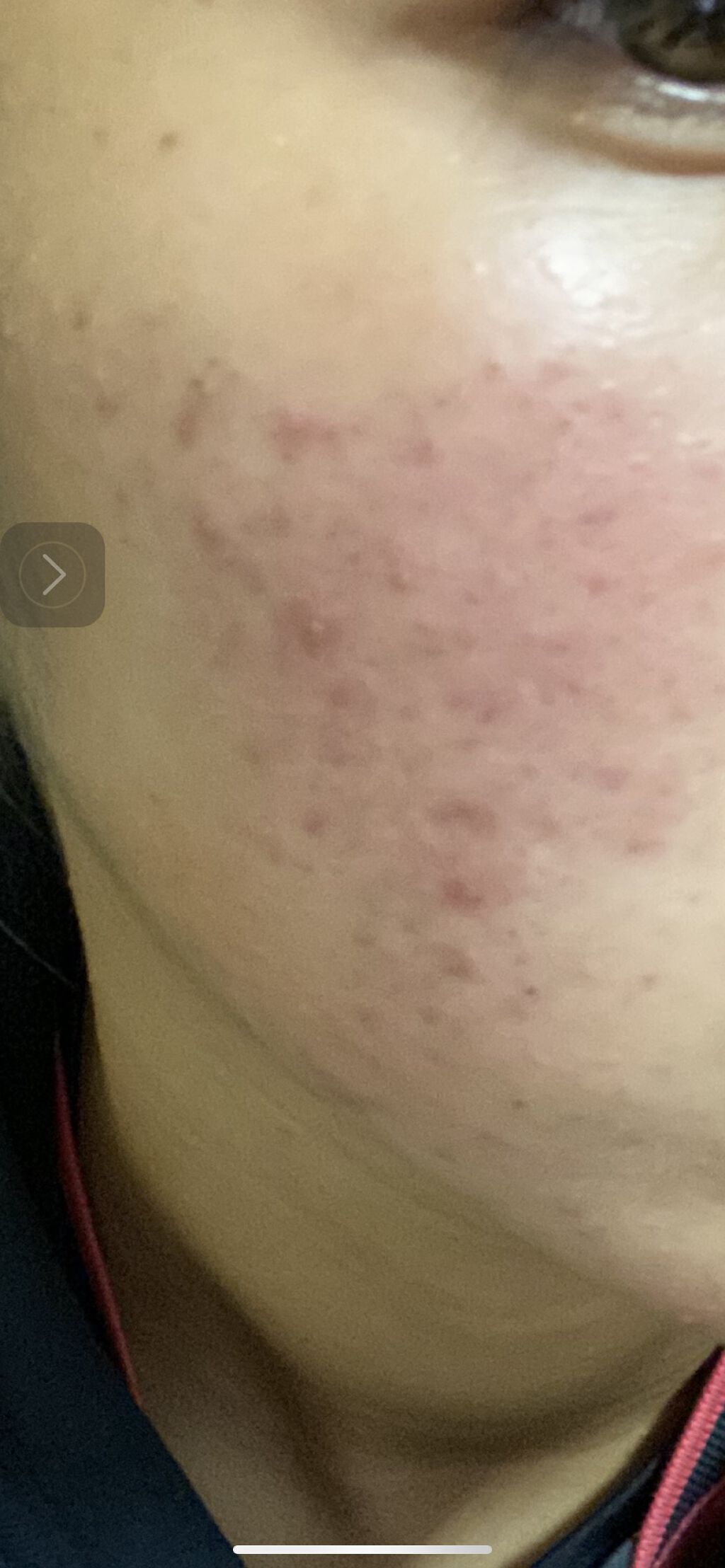 ニキビあとケアジェル/アットノン/その他スキンケアを使ったクチコミ（1枚目）