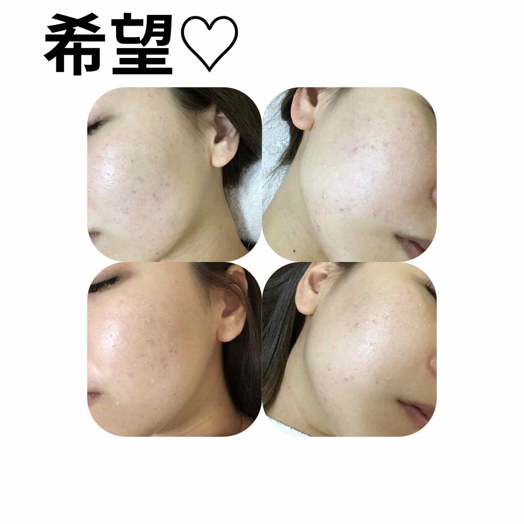ニョッキ on LIPS 「洗顔、保湿クリーム、ニキビ薬は皮膚科から処方されたものを使って..」(1枚目)