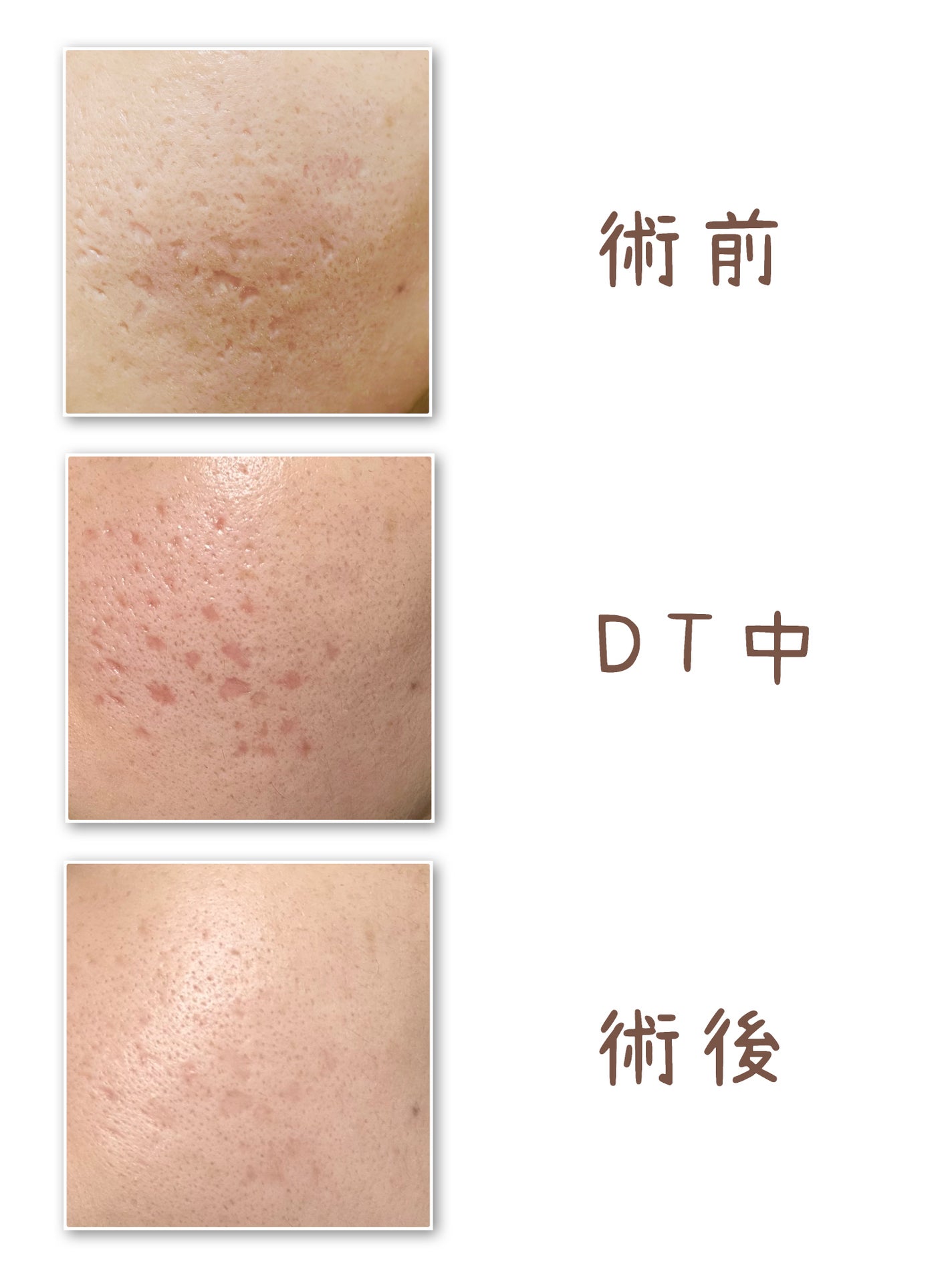 V on LIPS 「炭酸ガスレーザー&サブシジョンの経過についての投稿になります。..」(2枚目)
