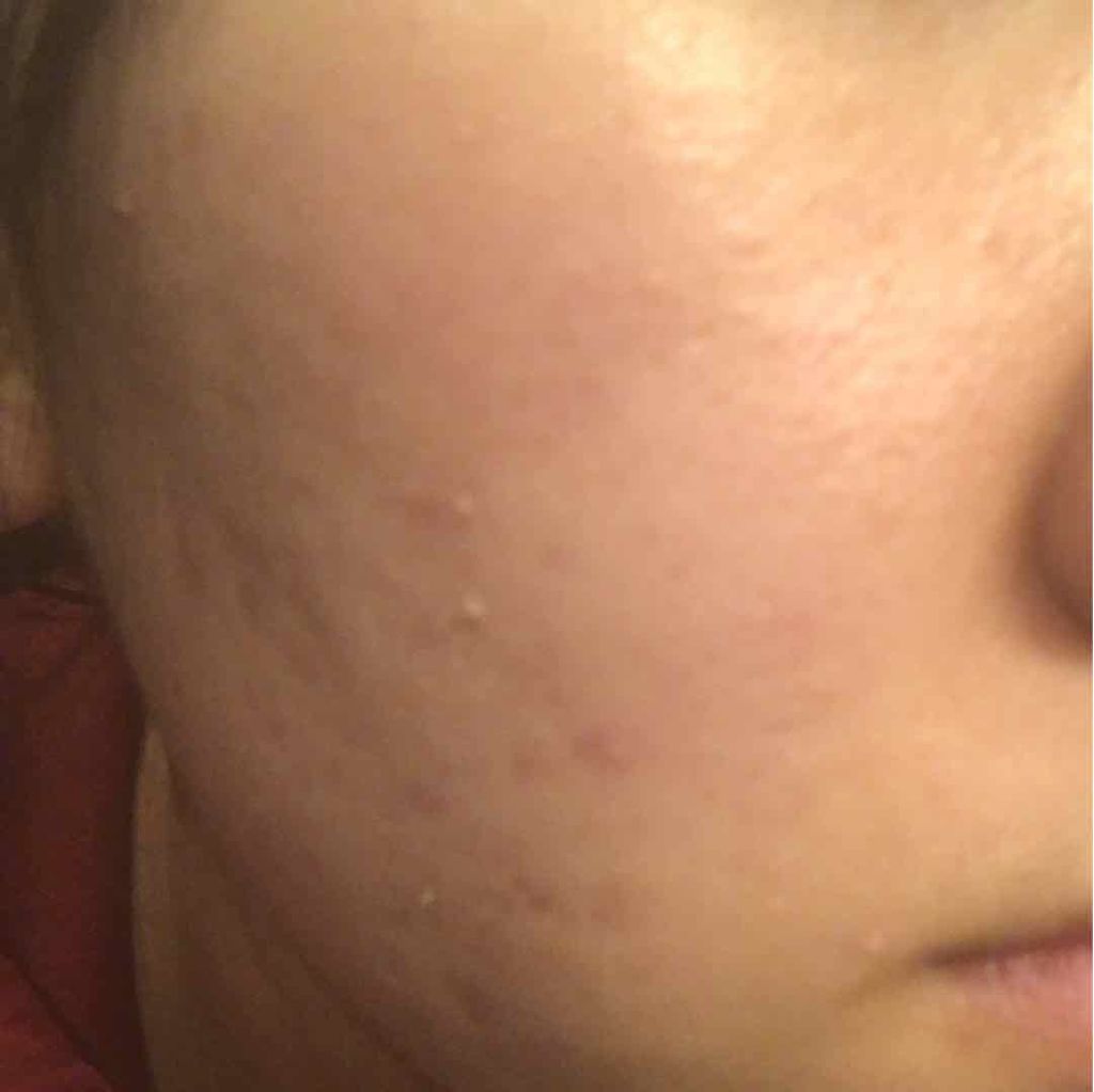 バイオイル/バイオイル/フェイスオイルを使ったクチコミ（2枚目）