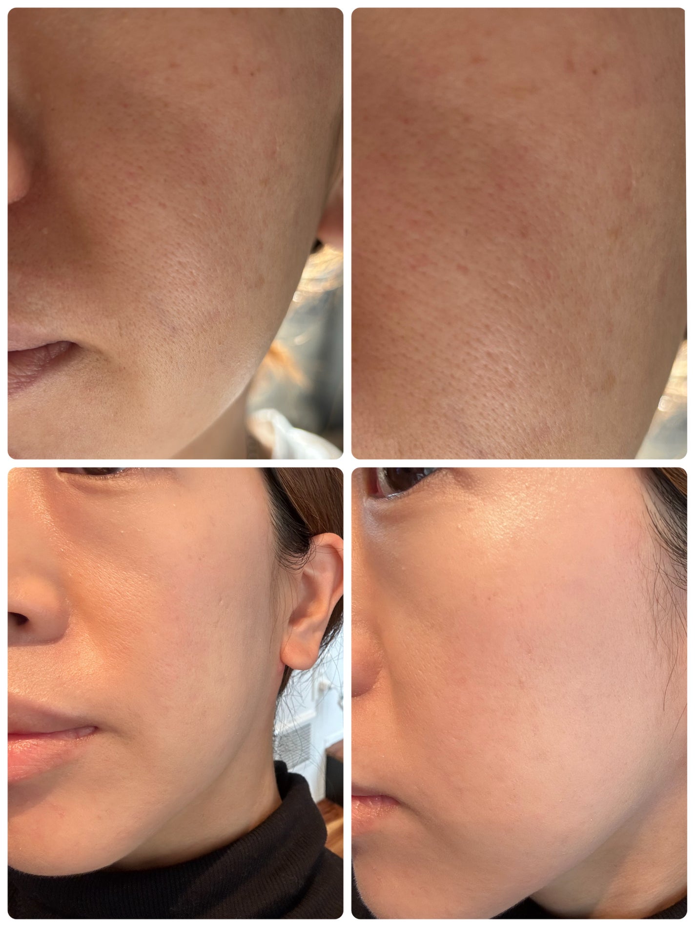 フィットミー コンシーラー/MAYBELLINE NEW YORK/リキッドコンシーラーを使ったクチコミ(1枚目)