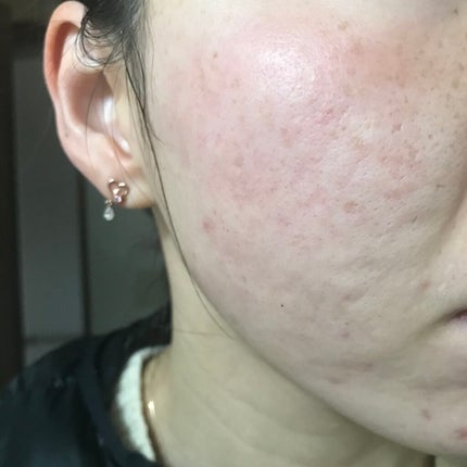 Azelaic Acid Suspension 10%/The Ordinary/美容液を使ったクチコミ(1枚目)