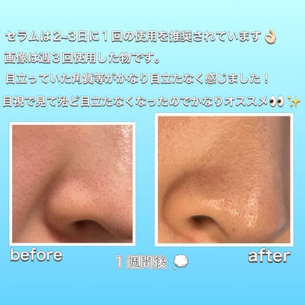 アップルミント AHA・BHA 10%リキッド/goodal/化粧水を使ったクチコミ(5枚目)