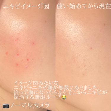 BIOHEAL BOH ダーマインテンシブシカパンテノールブラミッシュクリームのクチコミ「🌿 ニキビ・ニキビ跡・毛穴 にガチで効く 🌿

こんばんは、れいん(rai)🌧です。

今回は.....」（3枚目）