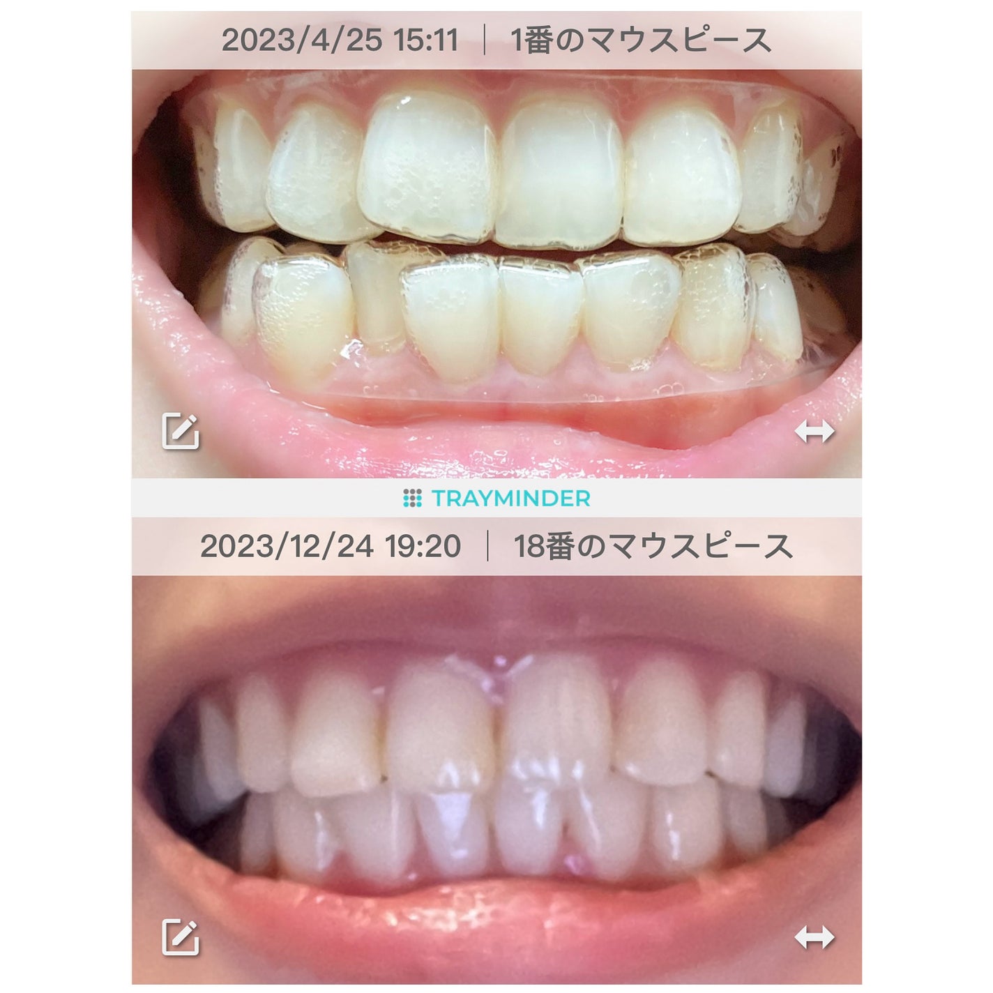 kaorico on LIPS 「.マウスピース矯正のGlorySmile(グローリースマイル..」(8枚目)