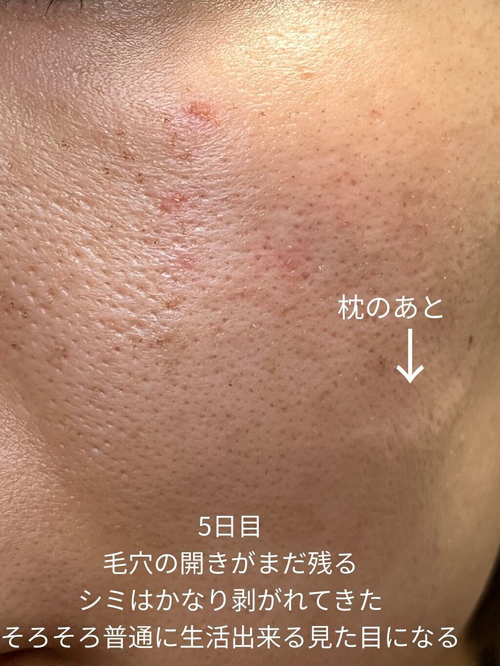 侘助 on LIPS 「【美容医療でシミ取り記録】こんにちは、侘助です❁❁❁今回は美容..」(6枚目)