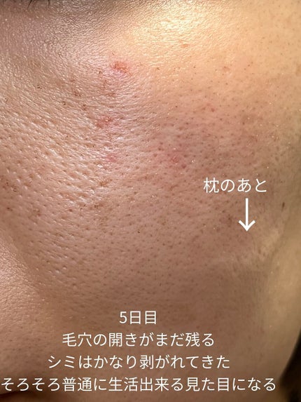 侘助 on LIPS 「【美容医療でシミ取り記録】こんにちは、侘助です❁❁❁今回は美容..」(6枚目)