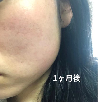 ベピオゲル/マルホ株式会社/その他を使ったクチコミ(3枚目)