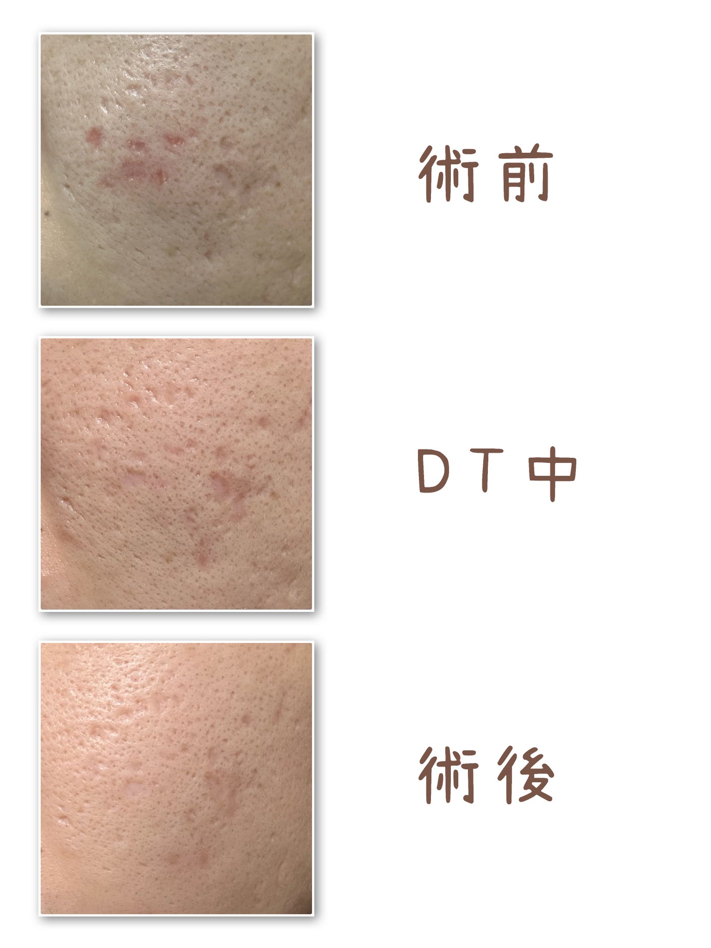 V on LIPS 「炭酸ガスレーザー&サブシジョンの経過についての投稿になります。..」(6枚目)