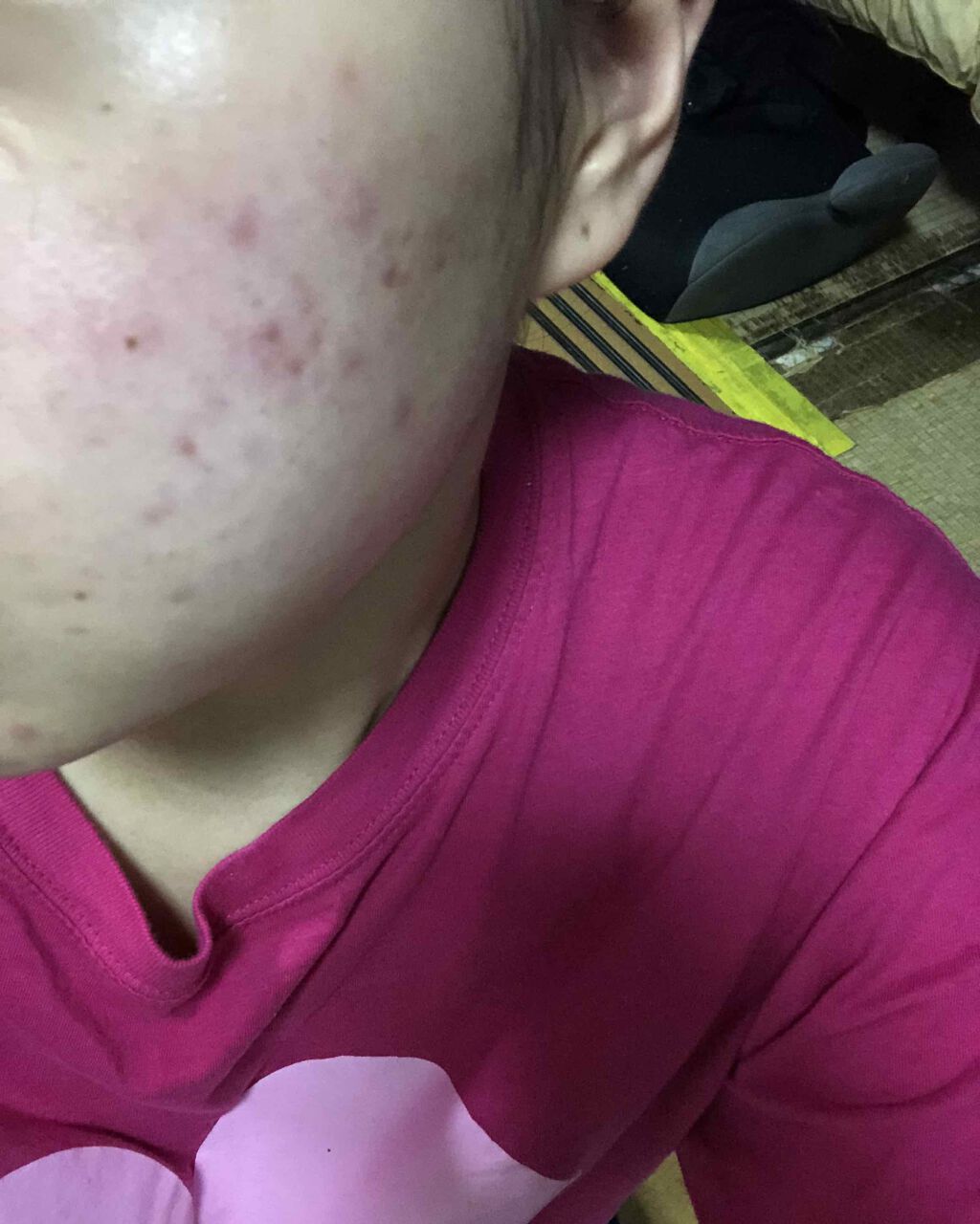 いずみ on LIPS 「#ニキビニキビ跡初めての投稿です!今22なのですが、にきびがな..」(1枚目)