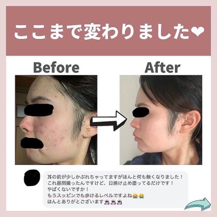 あなたの肌に合ったスキンケア💐コーくん先生 on LIPS 「実はニキビ酷かった!?桐谷美玲の衝撃ビフォーアフター😱あなたの..」(6枚目)
