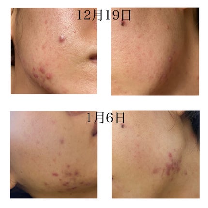 N10+Z1フェイスセラム /The Ordinary/美容液を使ったクチコミ(6枚目)