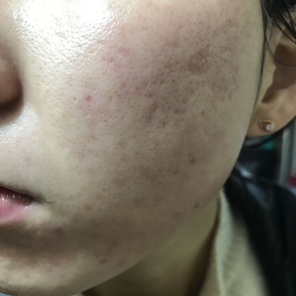 AZアゼライン酸10セラム/コスデバハ/美容液を使ったクチコミ（2枚目）