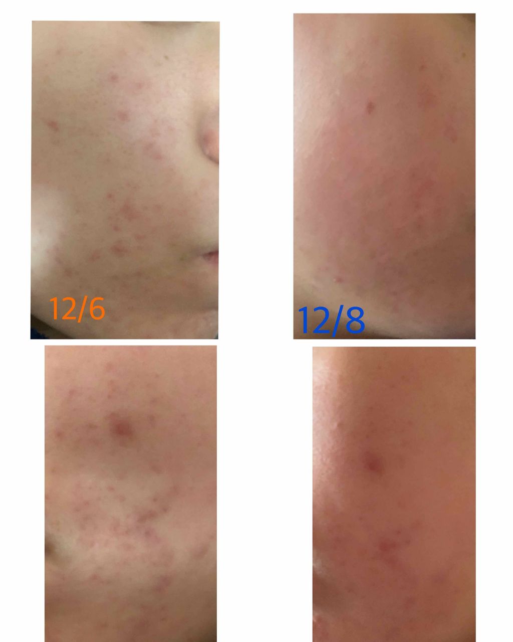 エピデュオゲル/マルホ株式会社/その他を使ったクチコミ（2枚目）