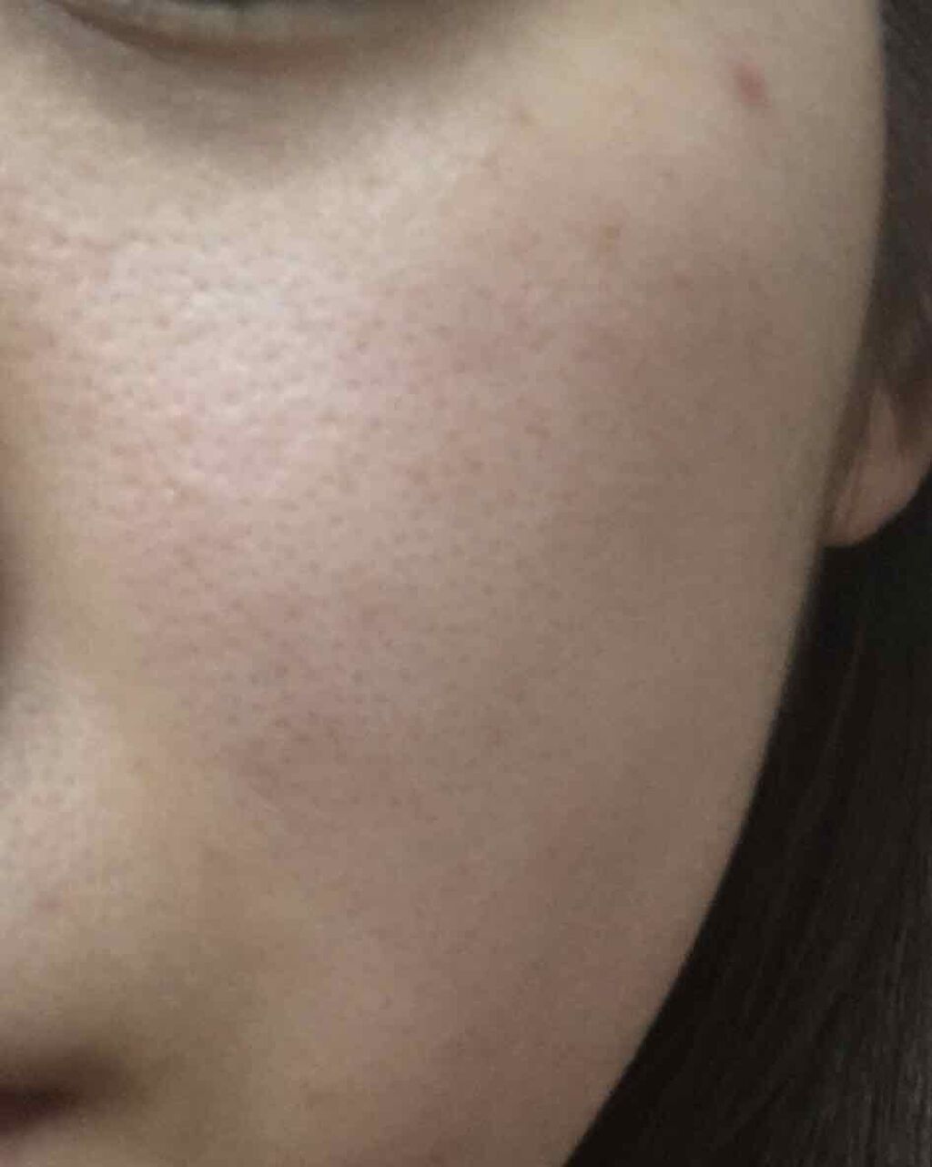 しゃんしゃん on LIPS 「結果的に言うと私的には皮膚科に行くのが一番手っ取り早いです!!..」(4枚目)