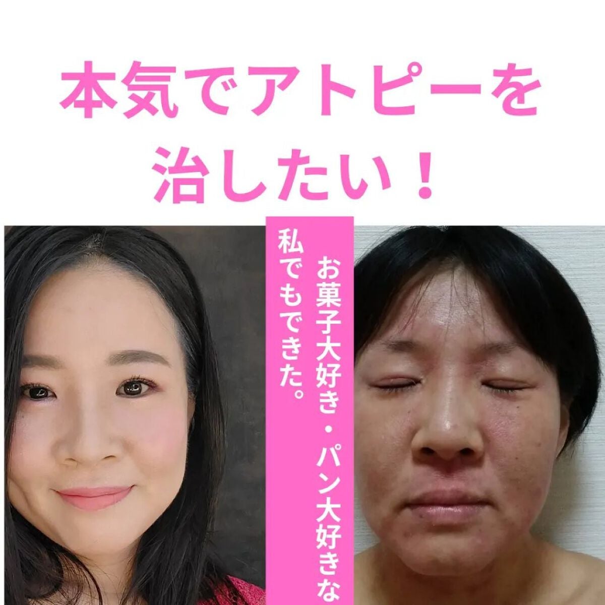 美肌カウンセラー💆肌悩みを解決し見る世界を変える on LIPS 「【本気でアトピーを治したい🧙♀️】心から願っているなら素直に..」(2枚目)