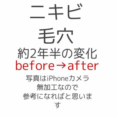 初投稿させて頂きます。

ここ2年半でだいぶニキビと毛穴が少し
良くなってきたと実感したので
いつもは見る専門ですが
投稿しようと思い載せてみました。

プロフ通り小学高学年からニキビと毛穴に
悩み続け