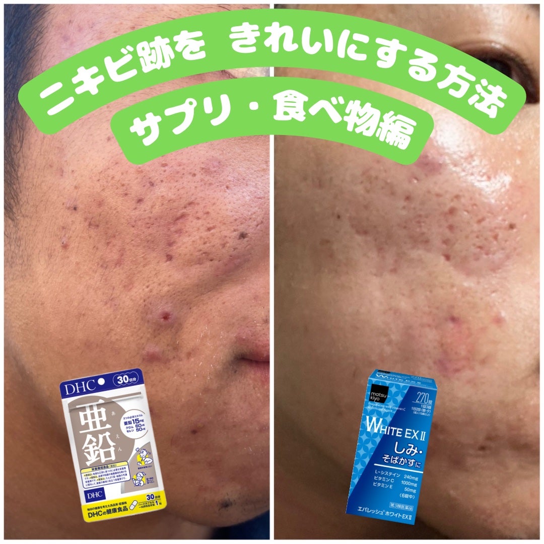 DHC 亜鉛/DHC/健康サプリメントを使ったクチコミ(1枚目)