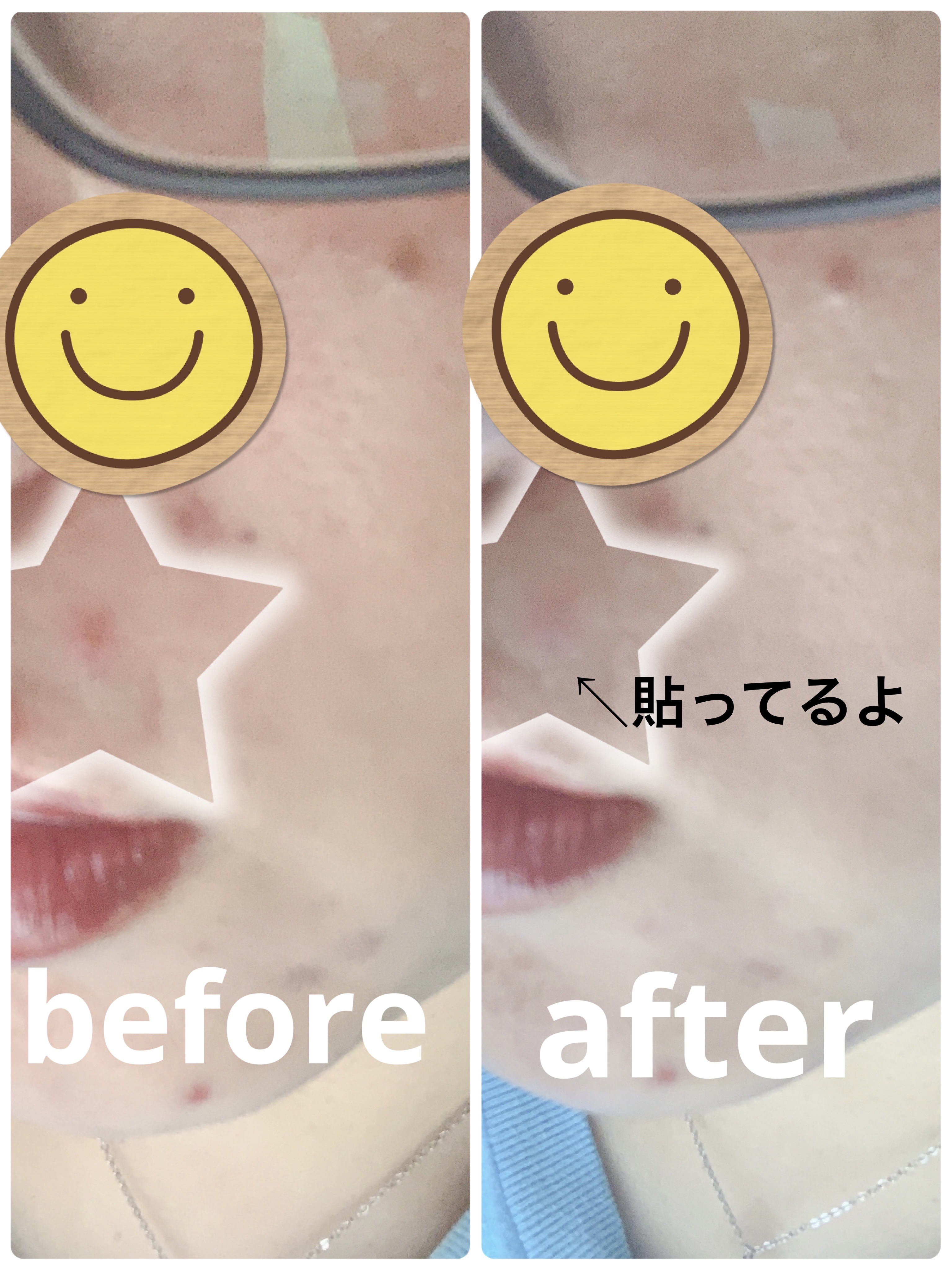 キャッチミーパッチ/CATCH ME PATCH/にきびパッチを使ったクチコミ（3枚目）