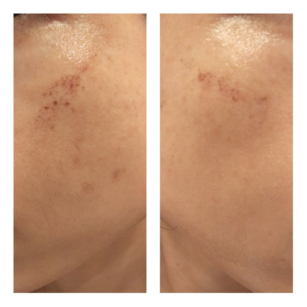 あにゃにゃ♡フォロバ100♡ on LIPS 「11/12に4回目のフォトシルクプラス(シミ取り)を受けてきま..」(3枚目)