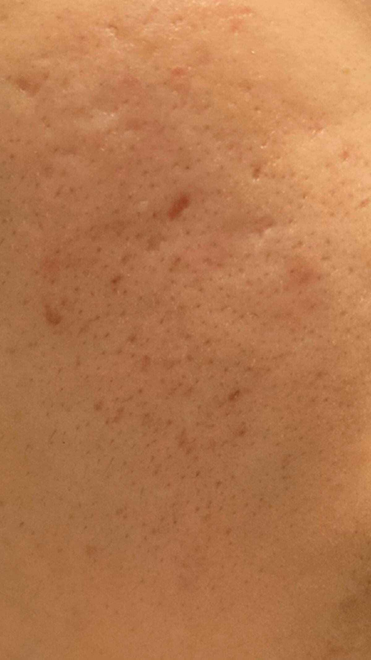 みんと on LIPS 「頬っぺの写真なんですけど、黒いプツプツは毛穴の黒ずみですか?治..」(2枚目)