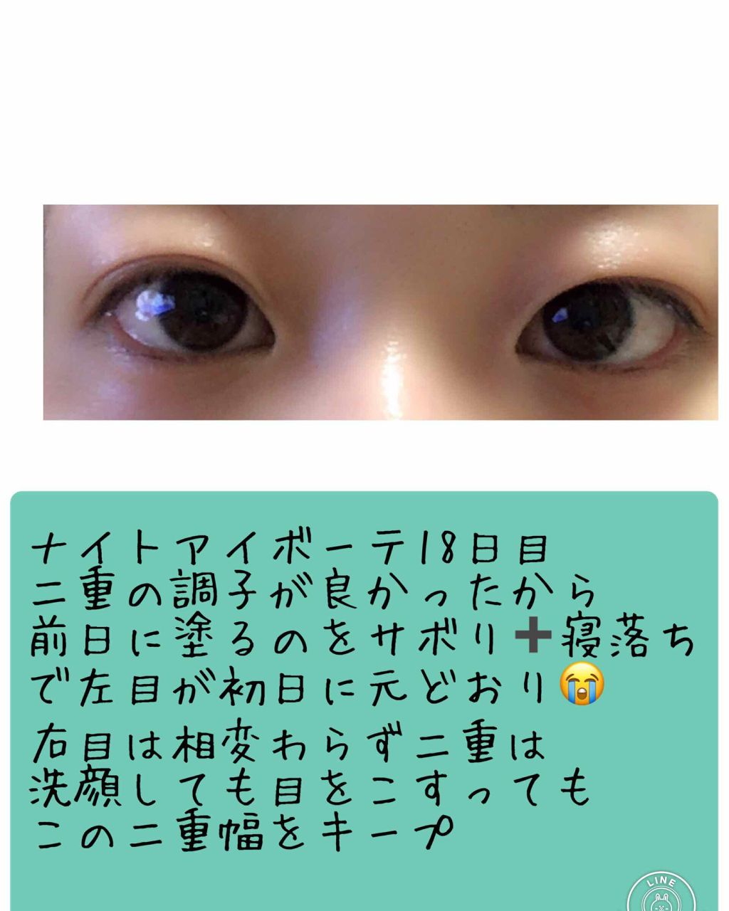 にゃー on LIPS 「ナイトアイボーテレポ②途中経過です12日目に二重幅が定まってき..」(3枚目)