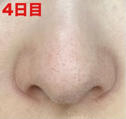 薬用 しみ 集中対策 美容液/メラノCC/美容液を使ったクチコミ(6枚目)