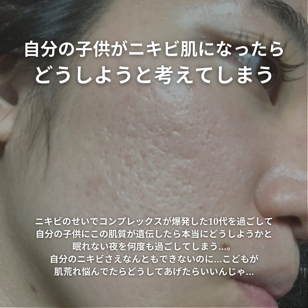 おゆみ|ニキビ・ニキビ跡ケア on LIPS 「@______ohyoume他の投稿はこちらから✊【ニキビが1..」(7枚目)