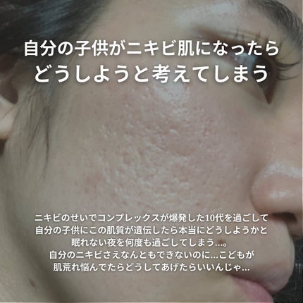 おゆみ|ニキビ・ニキビ跡ケア on LIPS 「@______ohyoume他の投稿はこちらから✊【ニキビが1..」(7枚目)